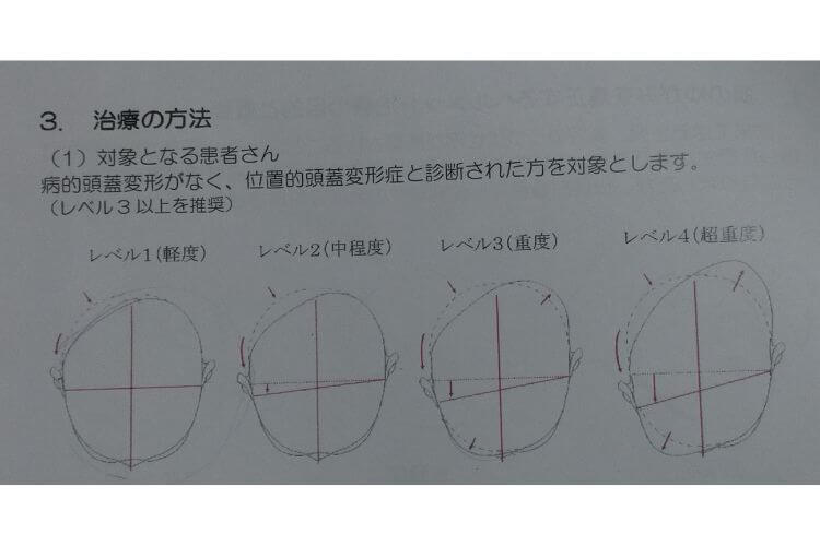 頭のかたちのレベル