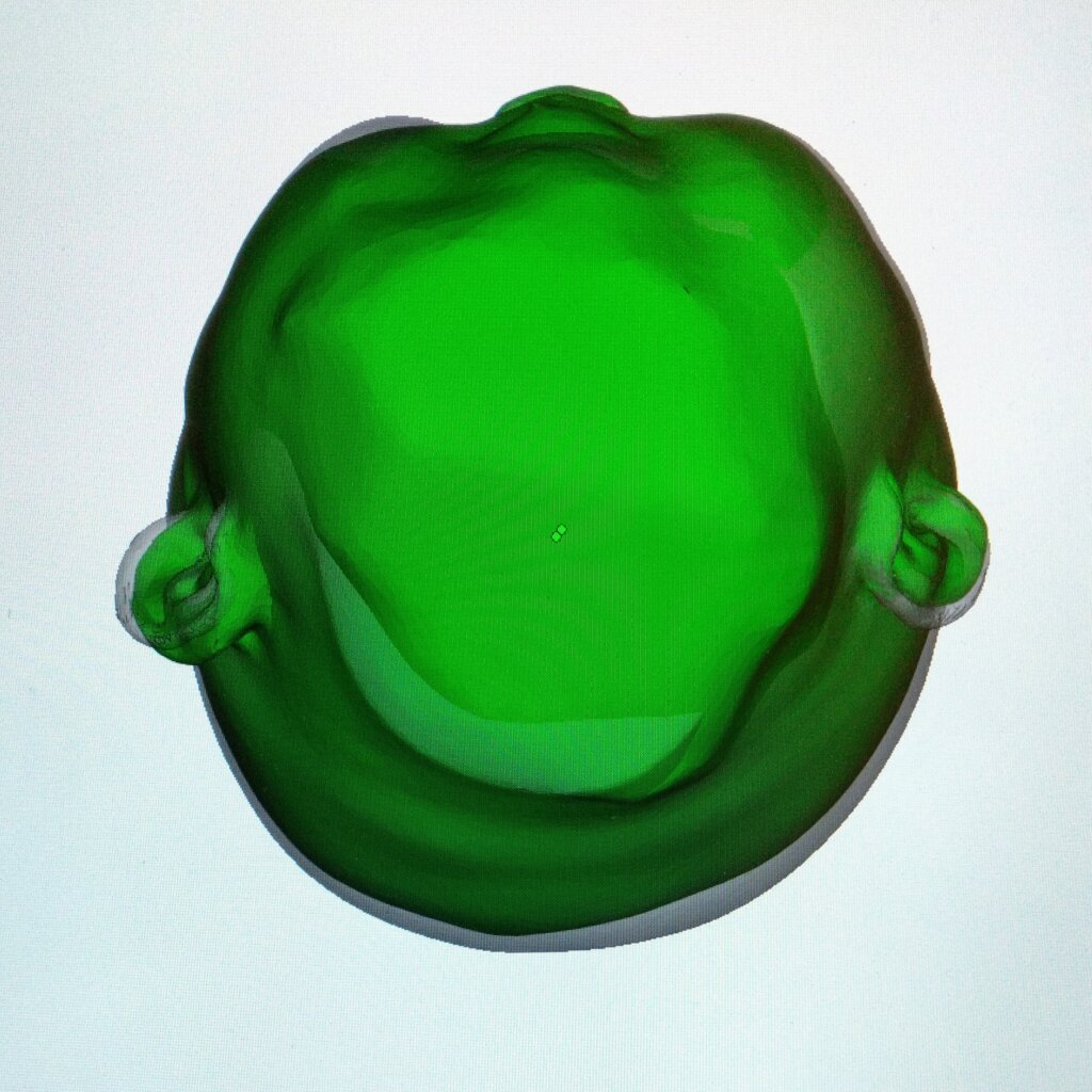 ヘルメット治療3D画像