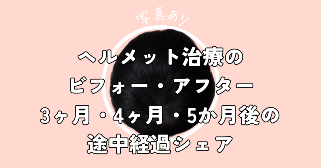 【画像付】ヘルメット治療のビフォー・アフター｜3ヶ月・4ヶ月・5か月後の途中経過